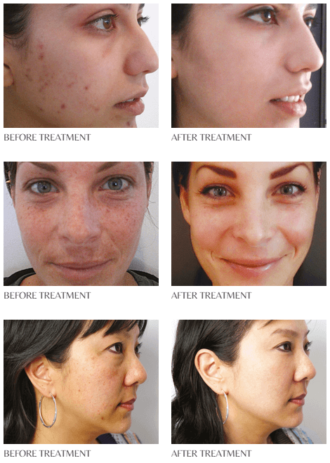 the perfect peel scottsdale