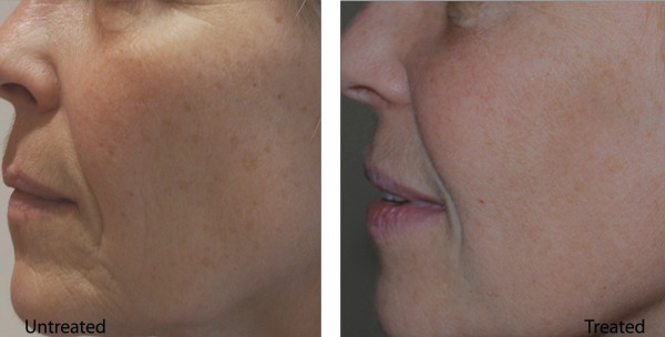 skin infusion therapy