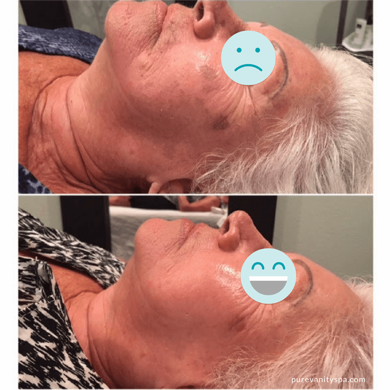 Perfect Peel Before and After