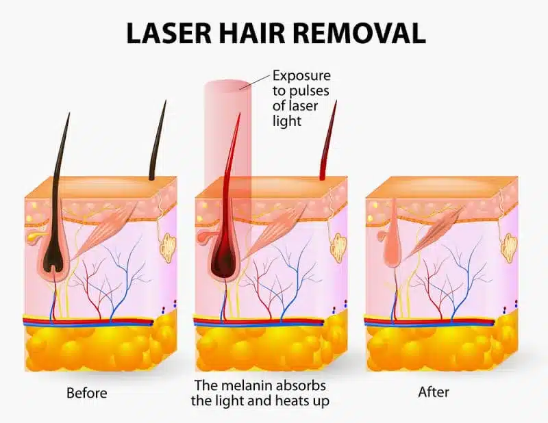 laser hair removal in Arizona, pain-free laser hair removal near me, face lifts near me, body contouring in Scottsdale, anti-aging and anti-acne light therapy in Scottsdale