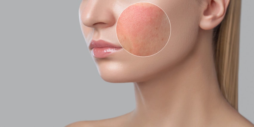 Calm the Chaos: Top Ingredients to Soothe and Heal Skin