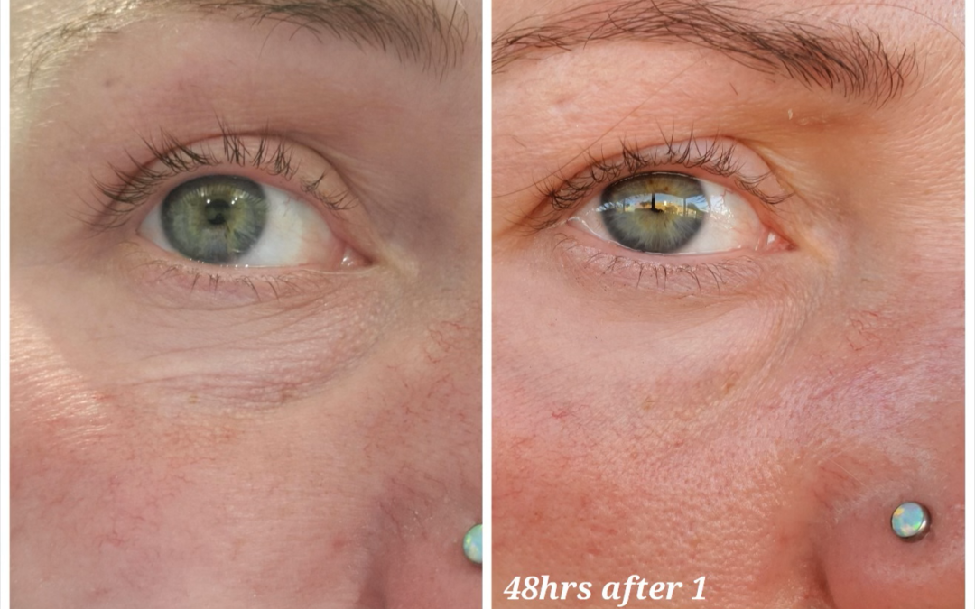 The Secret to Radiant, Youthful Skin Without the Downtime